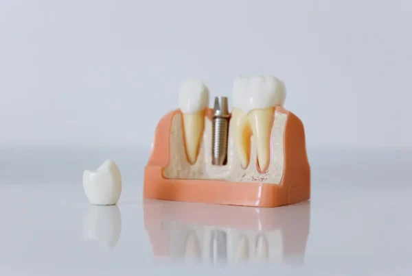 Uncovering dental implants