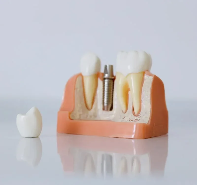 Uncovering dental implants