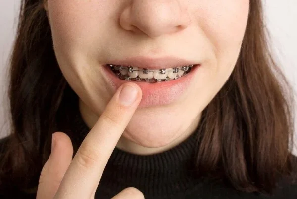 Difference Between Fastbraces and Traditional Braces: Which Is Right for You