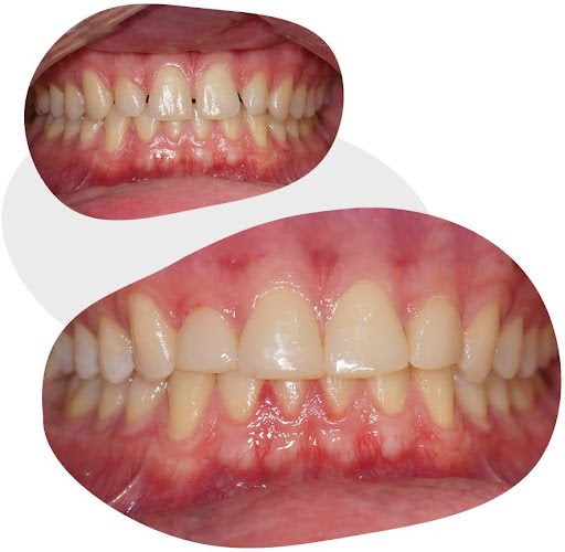 Porcelain Veneers Before and After