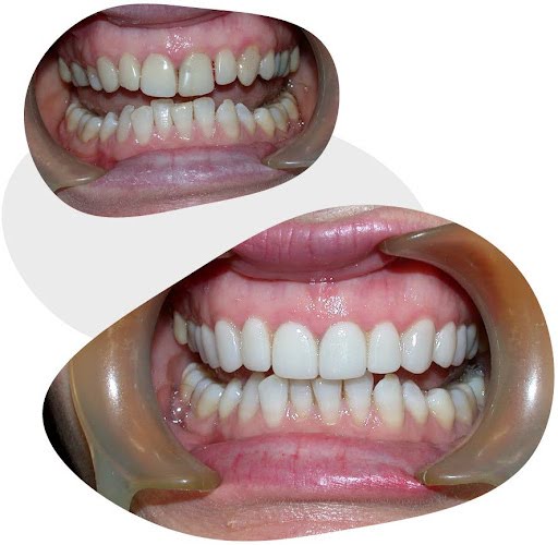 Porcelain veneers before and after