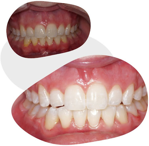before and after teeth whitening session in Adelaide