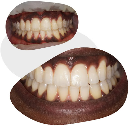before and after teeth whitening session in Adelaide