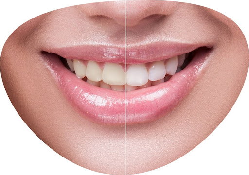 Sparkling white smile – the result of a session of teeth whitening in Adelaide