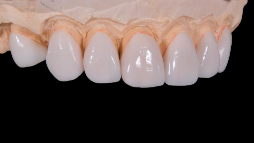 A type of dental crown
