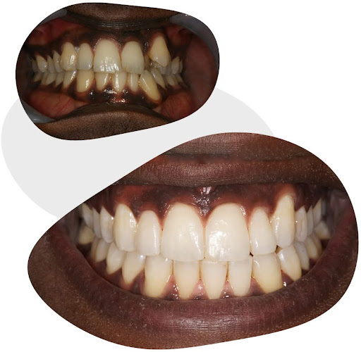 Before and after how brace-wearing leads to change in teeth shape