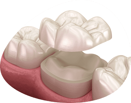 What a dental crown looks like