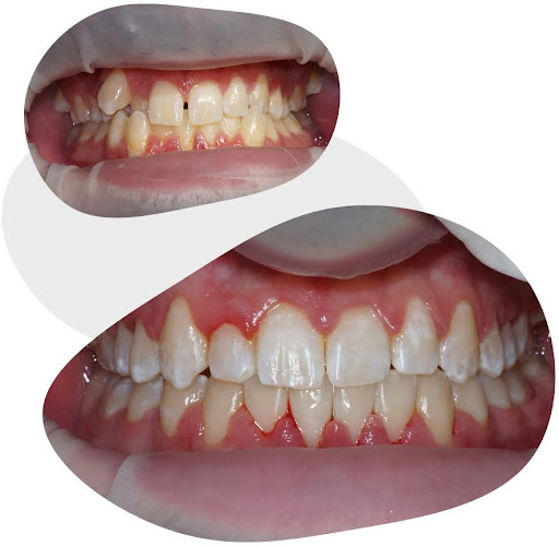 What your teeth look like after brace fixing