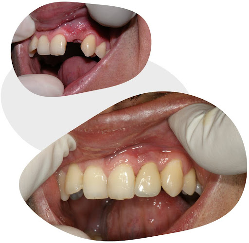 Dental implant upper left lateral incisor