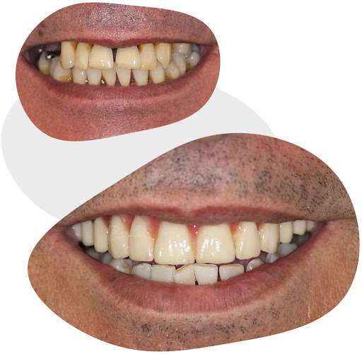 Full denture on implants (upper)