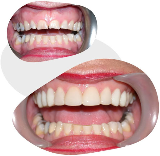 before and after a dental procedure for a client at Alpha Dental and Implants Centre, Prospect, near Broadview
