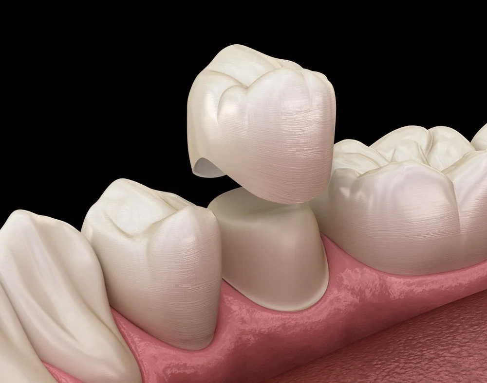 application of dental crown application of dental crown