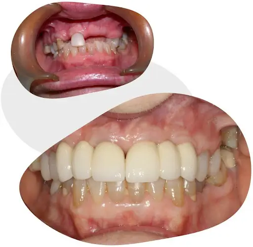 before and after a dental implant process at alpha dental and implant centre before and after a dental implant process at alpha dental and implant centre