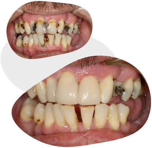 before and after of tooth coloured restoration