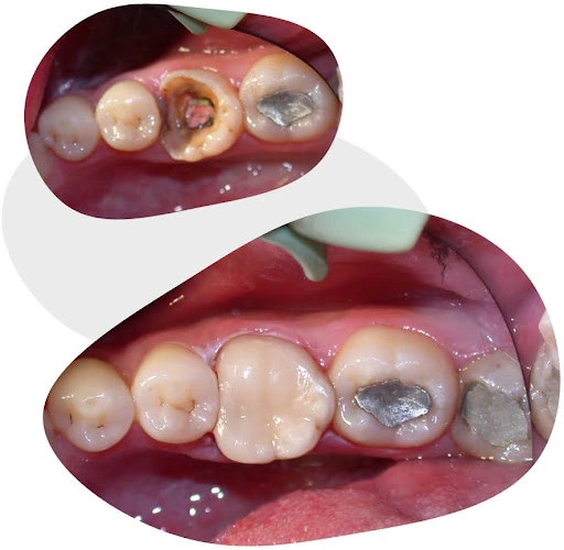 before and after tooth coloured restoration