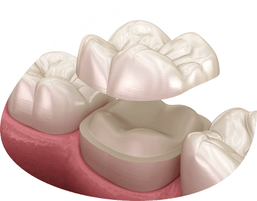 dental crowns adelaide