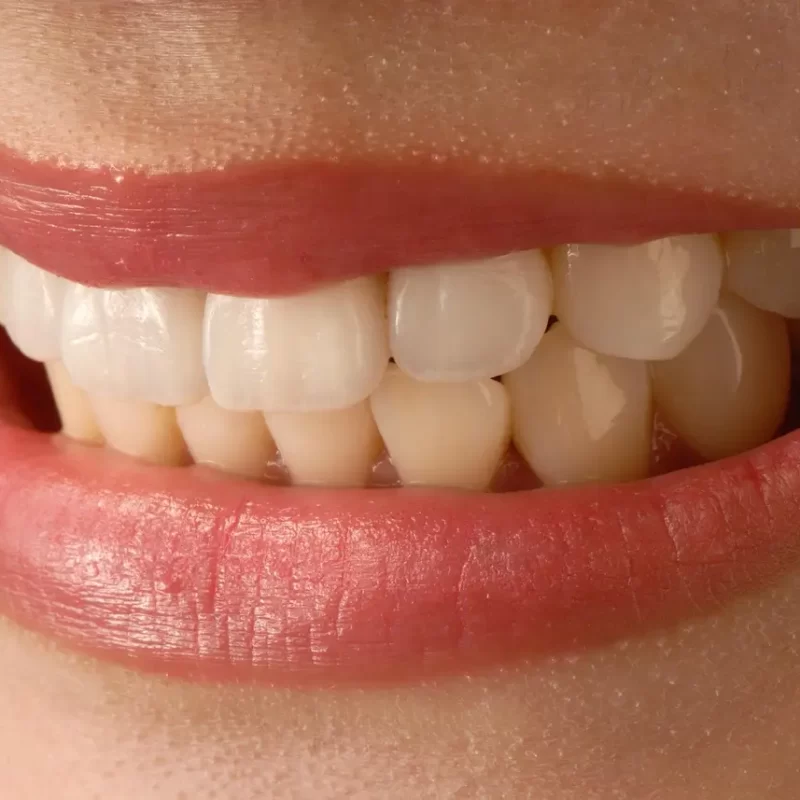 dental crowns vs veneers