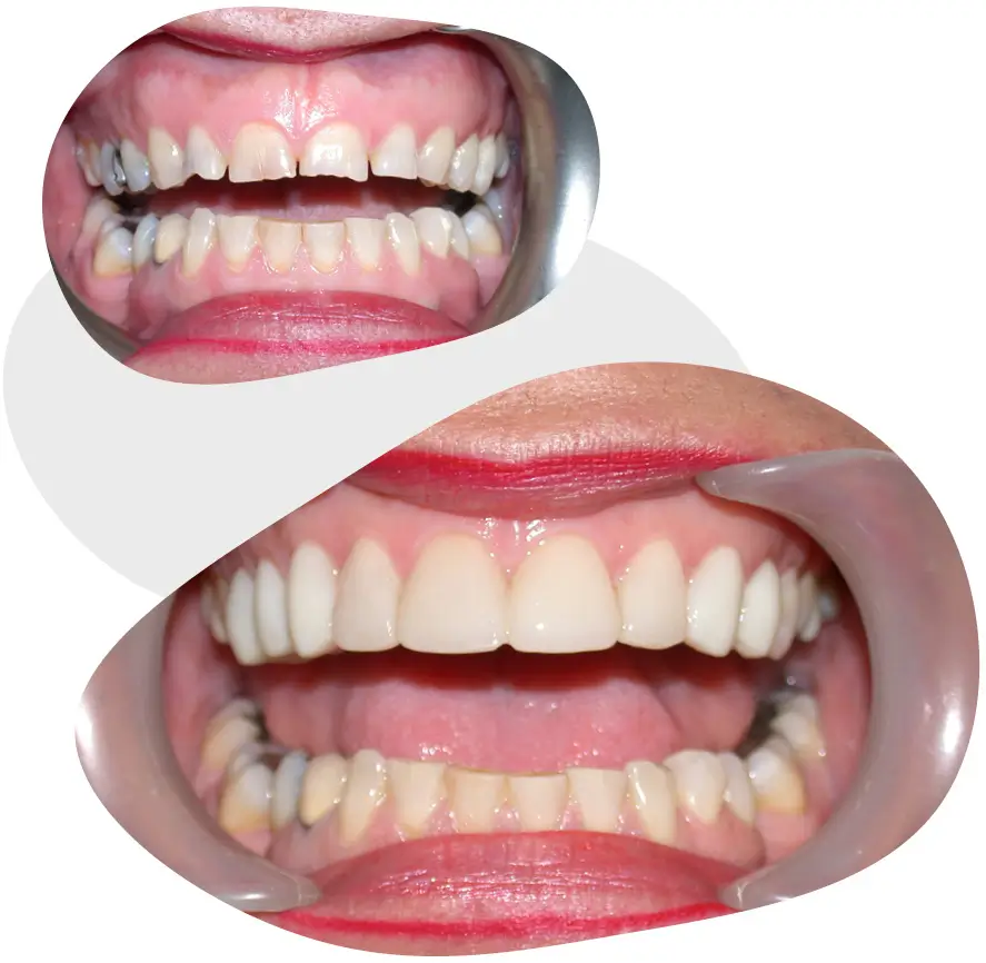 dental implants in prospect before and after