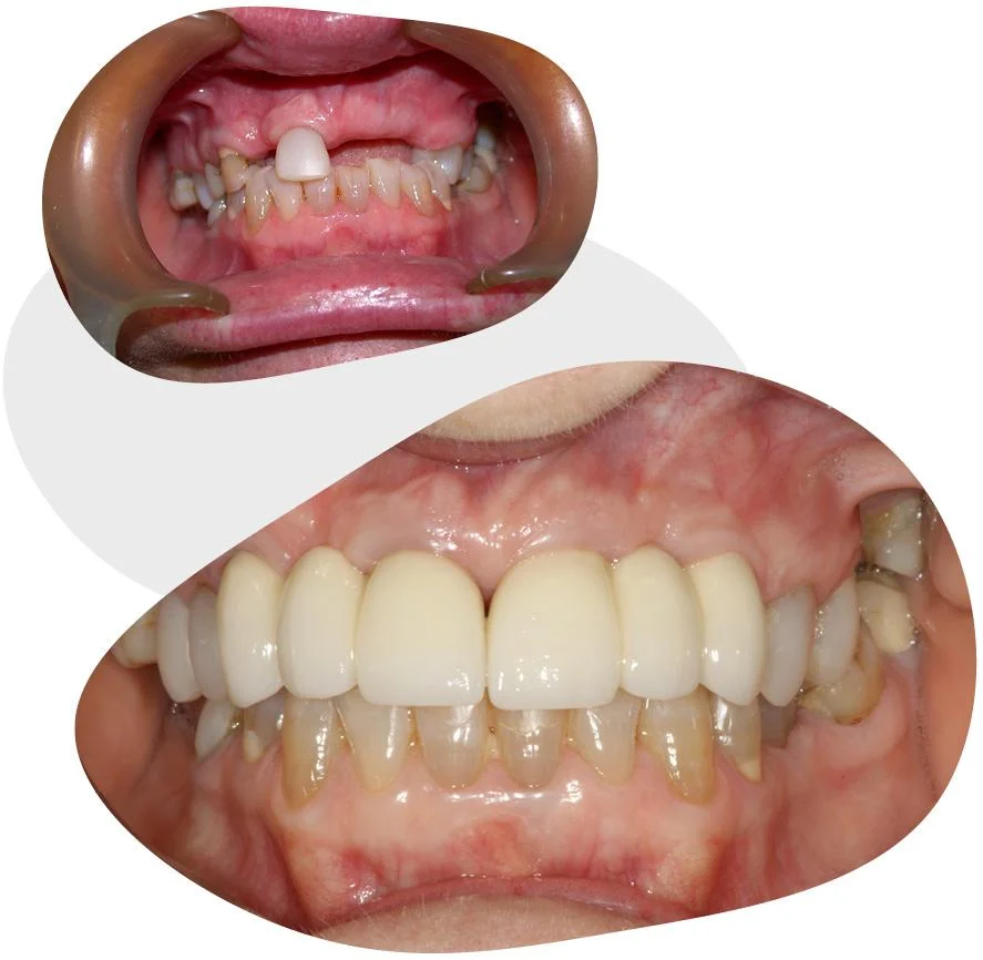 dental implants near thorngate before and after