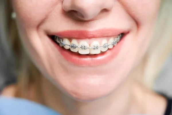 how long do braces stay on for