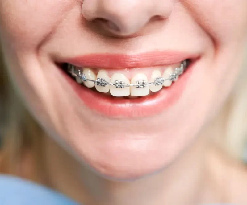 how long do braces stay on for