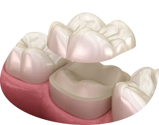 A 3d illustration of a porcelain dental crown being placed over a prepared molar tooth A 3d illustration of a porcelain dental crown being placed over a prepared molar tooth