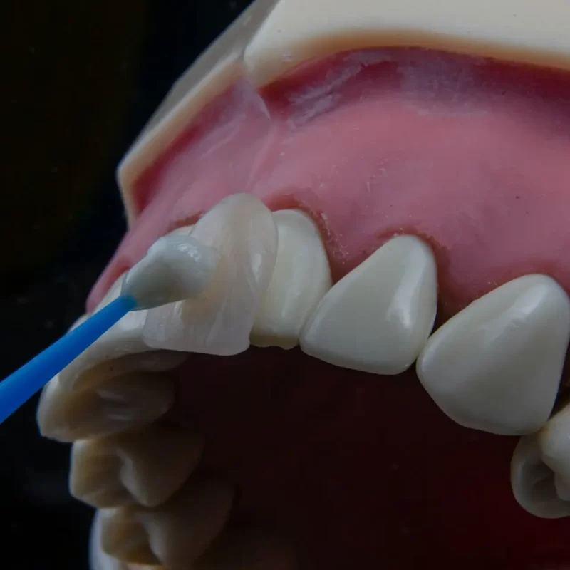natural looking veneers
