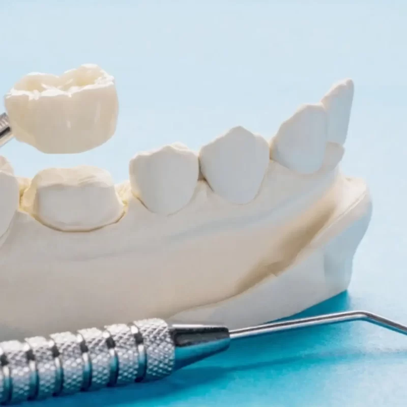 one of common types of dental crown