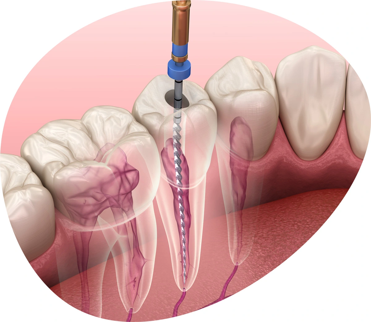 root canal therapy
