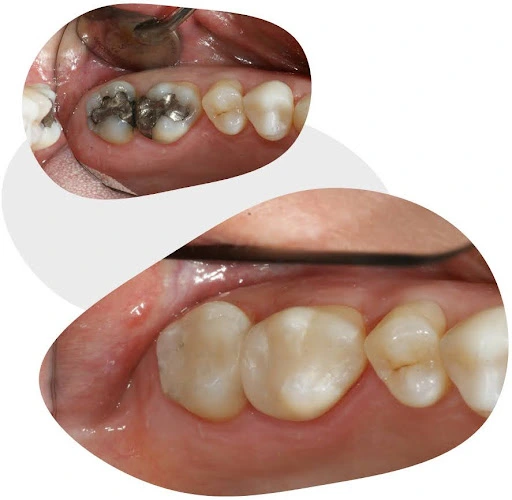 tooth coloured restoration