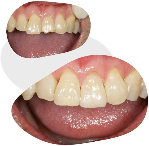 tooth coloured restoration