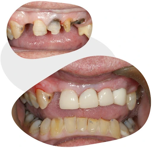 tooth coloured restoration before and after
