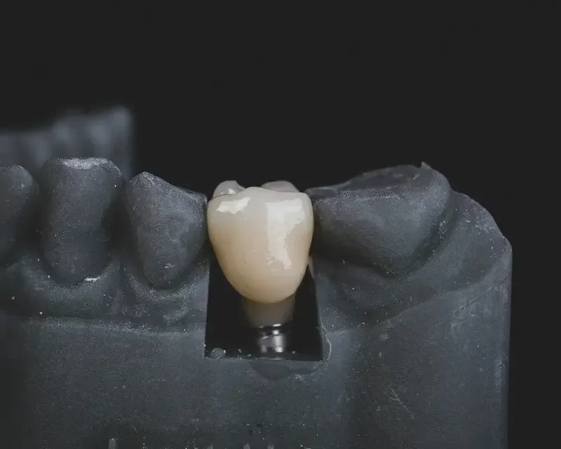 types of dental crowns