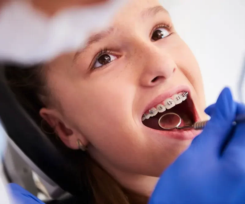 wondering what are ceramic braces