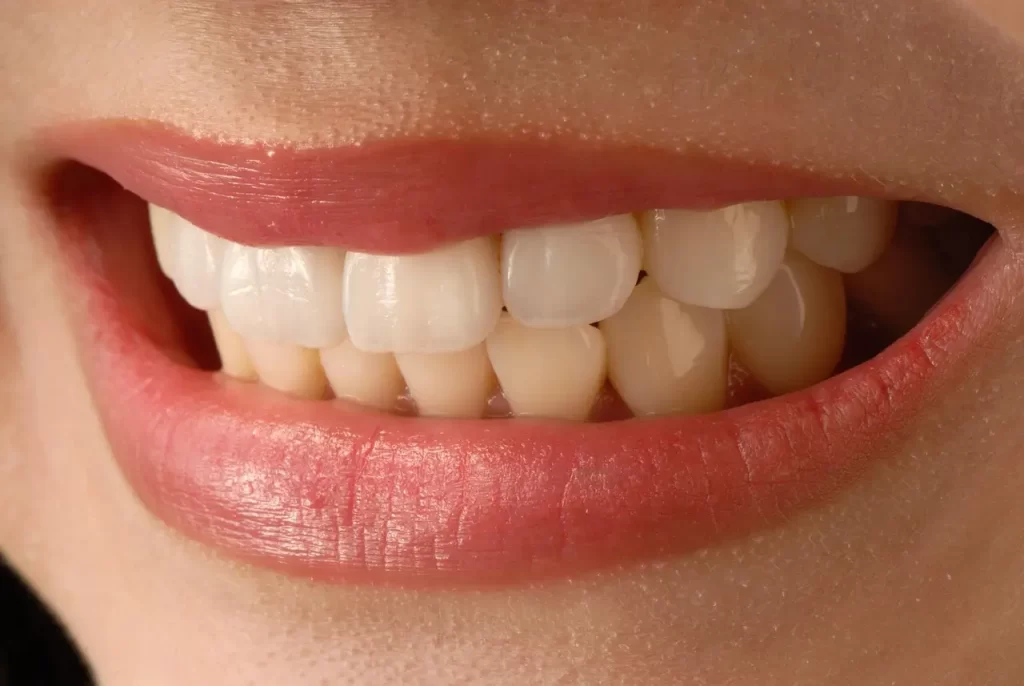 close-up smile showing teeth for dental bridge vs Implant in australia close-up smile showing teeth for dental bridge vs Implant in australia