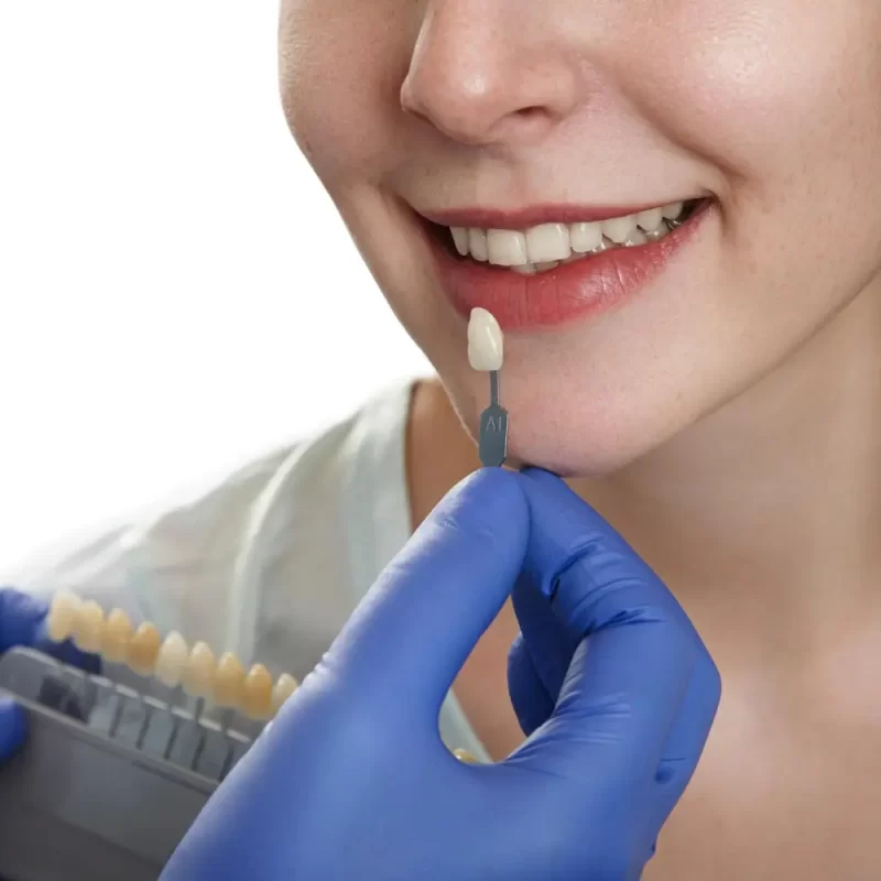 composite resin veneers