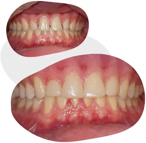 before and after of a composite resin veneer session before and after of a composite resin veneer session