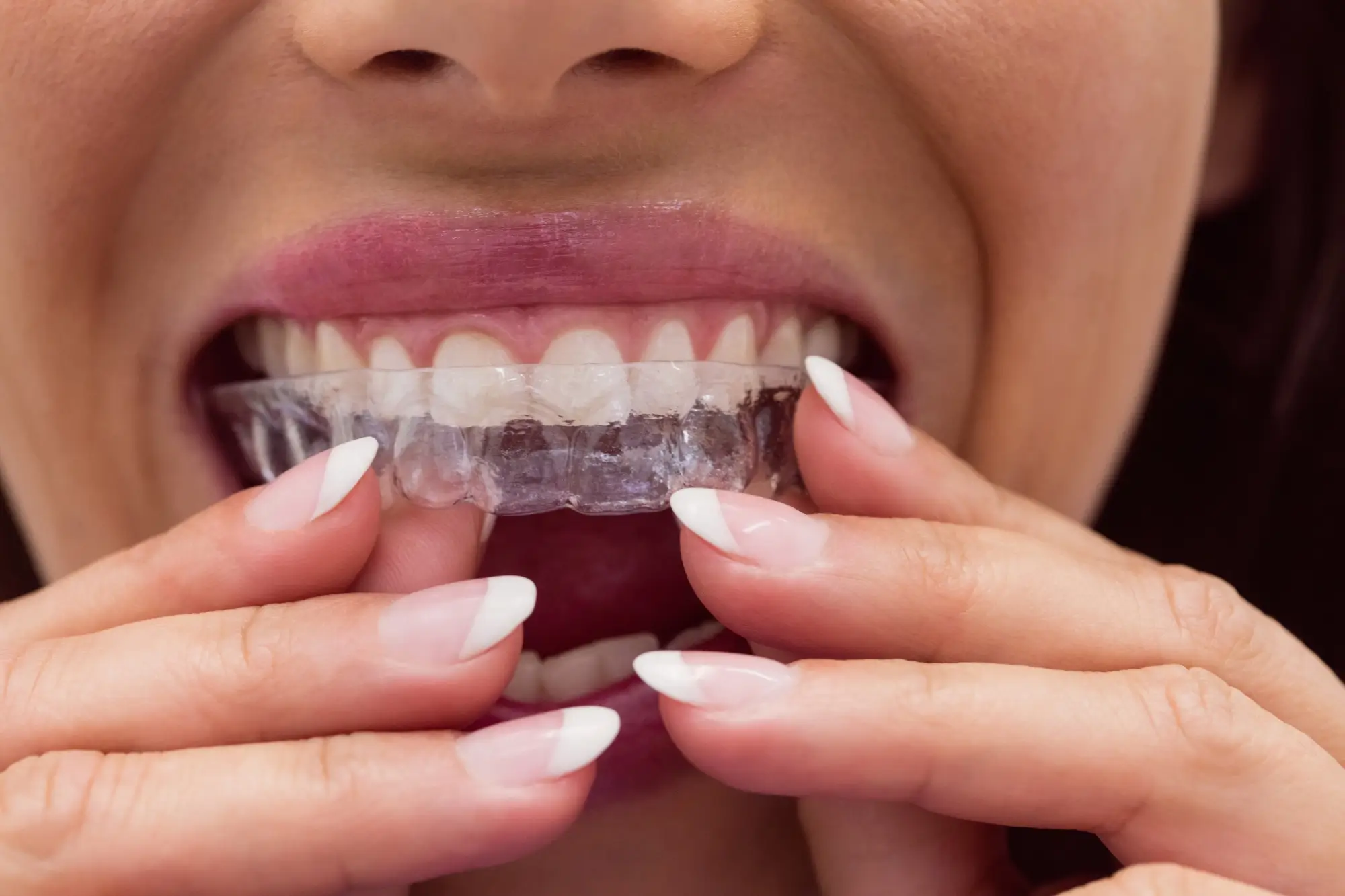 adelaide invisalign